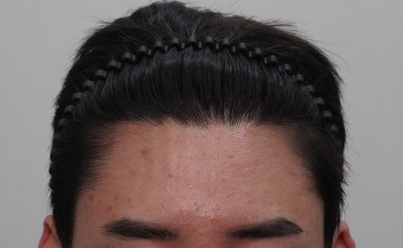 뉴헤어부산의원에서 8번째 치료받고 왔습니다