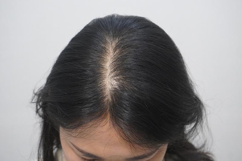 뉴헤어부산의원에서 2달 정도 치료 받은 후기 입니다