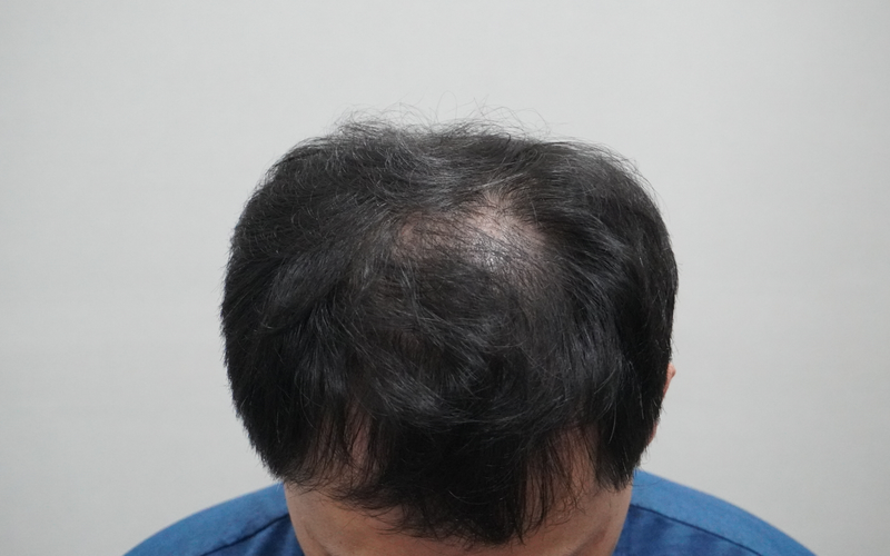 뉴헤어의원 부산점 다녀왔습니다~~