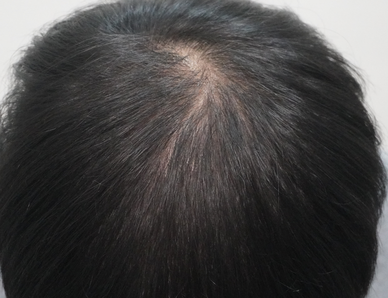 뉴헤어부산의원에서 8회차 주사치료 받고 왔습니다