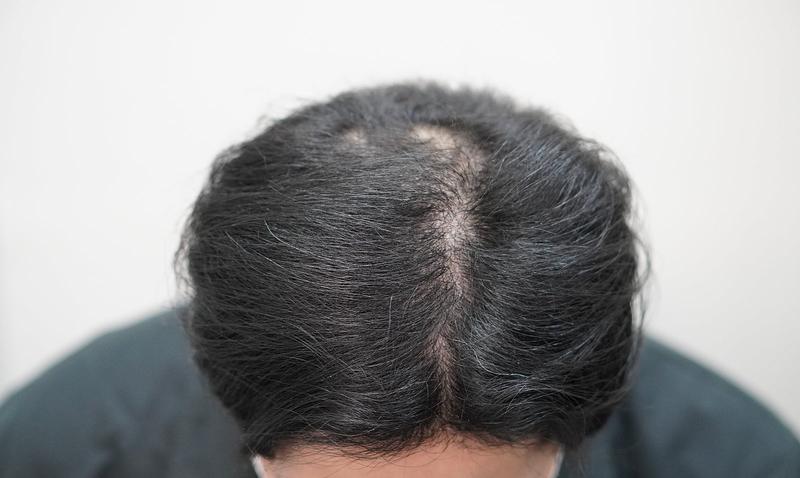 [釜山店] New Hair 医院 注射治疗 5个月后期