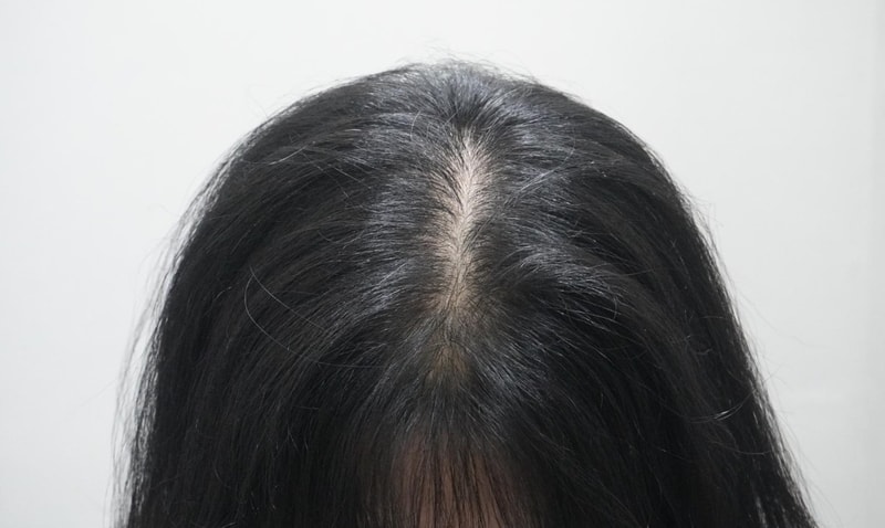 뉴헤어부산의원 탈모 치료 1회차