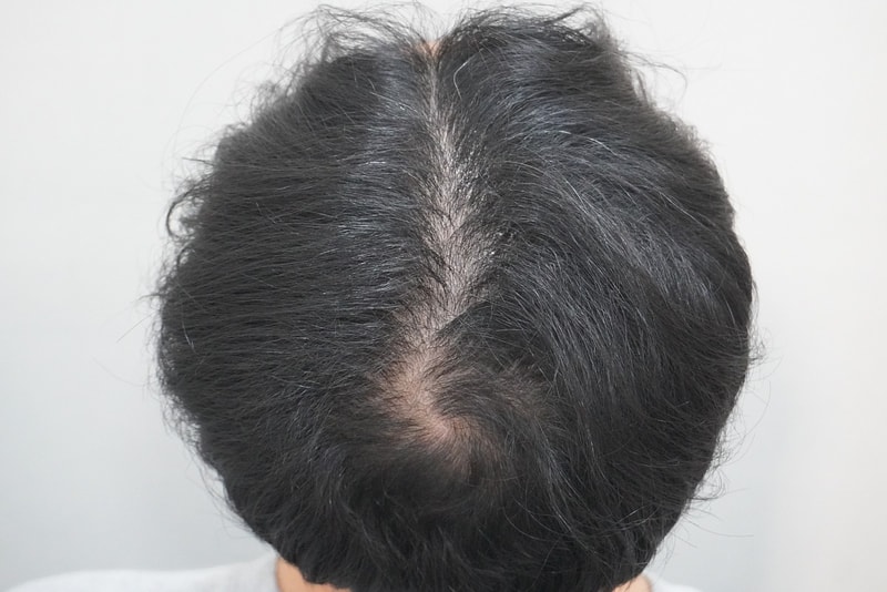 뉴헤어부산의원에서 탈모 치료 한달 후기