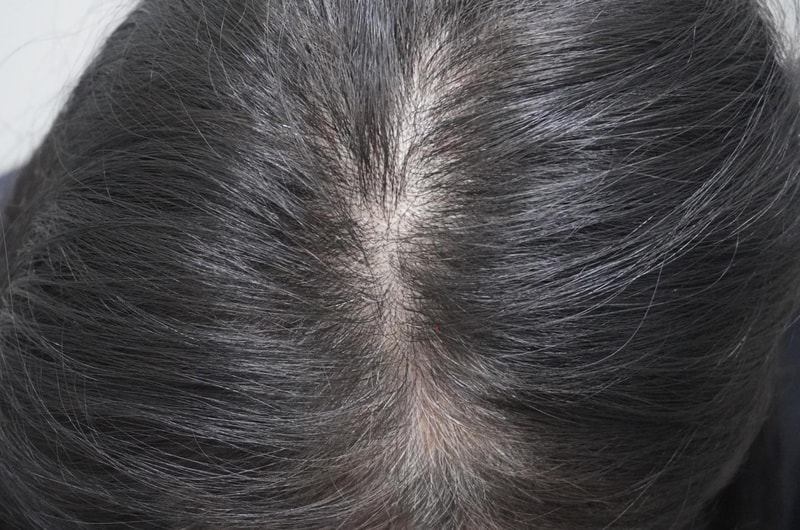 뉴헤어 부산점 탈모 주사시술 1회차 후기