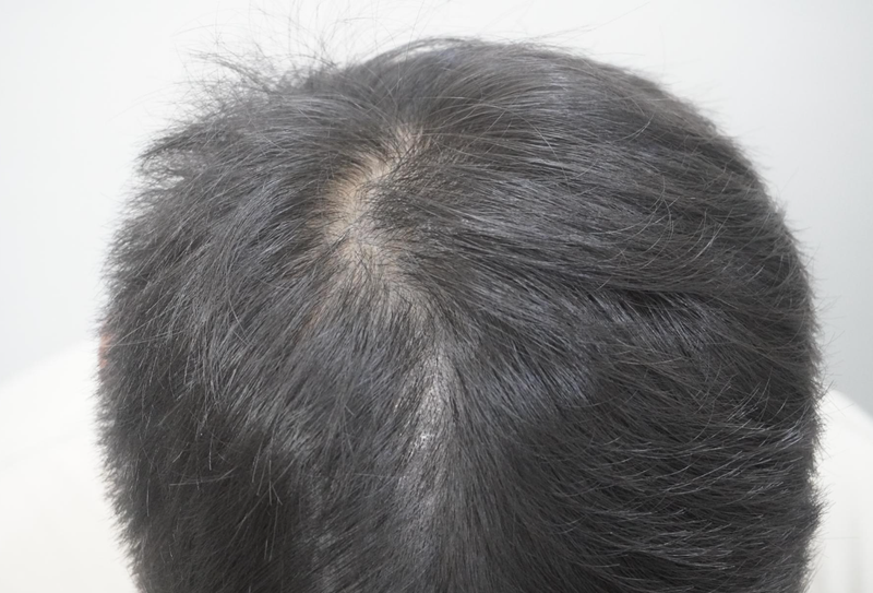 [부산점]뉴헤어모발성형외과에서 4회 차 탈모치료 후기