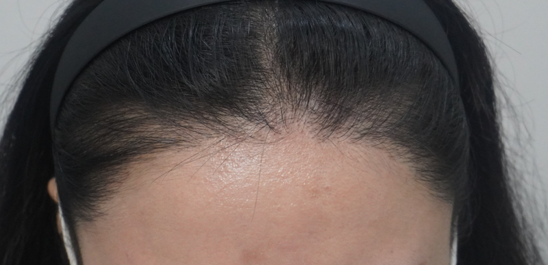 부산 뉴헤어의원에서 내돈내산 탈모 상담과 치료 후기