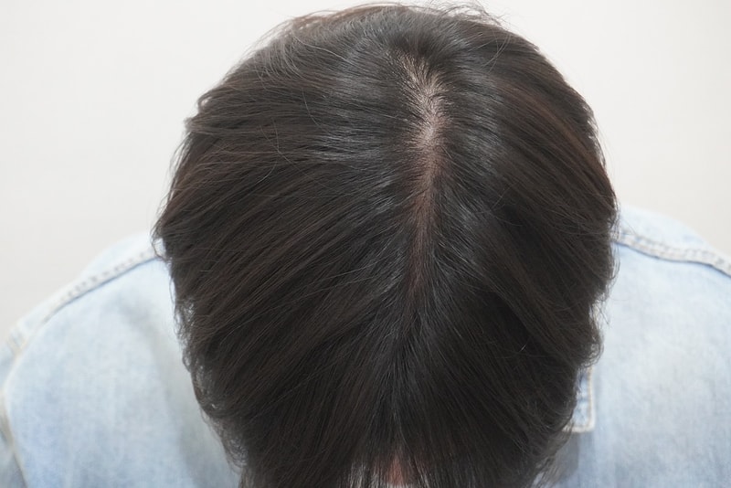 뉴헤어부산점에서 8회 차 탈모 치료 후기 입니다