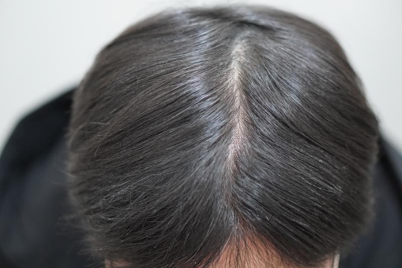 뉴헤어부산의원에서 주사치료 12회차 치료중입니다