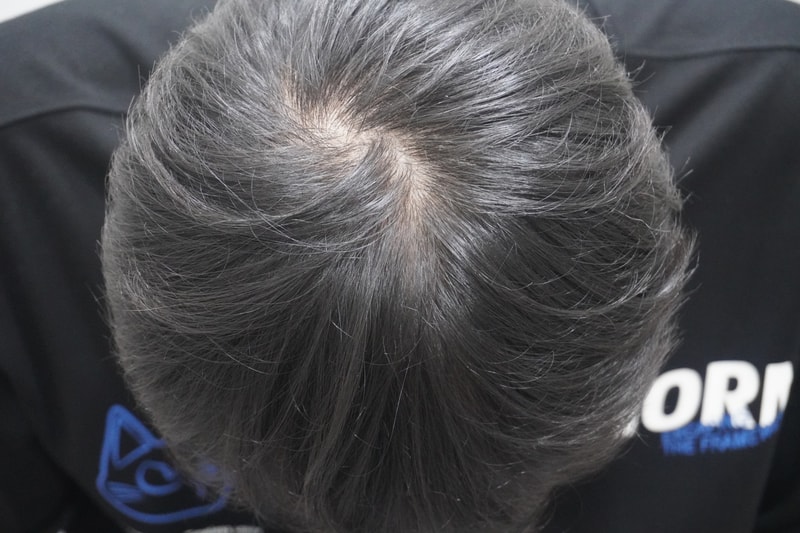 뉴헤어부산의원 탈모 시술 후기입니다