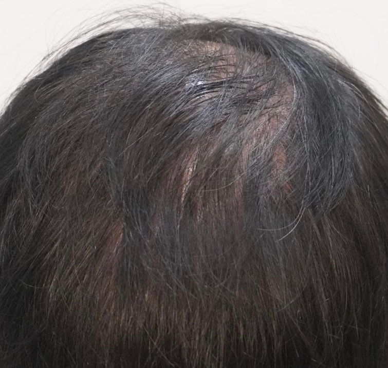 뉴헤어부산의원에서 치료받고 있어요