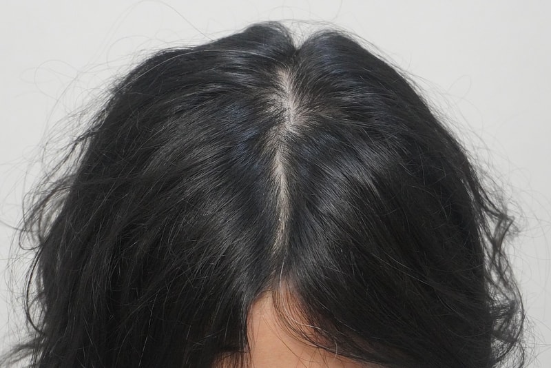 뉴헤어 부산점 에서 탈모치료 4회차입니다