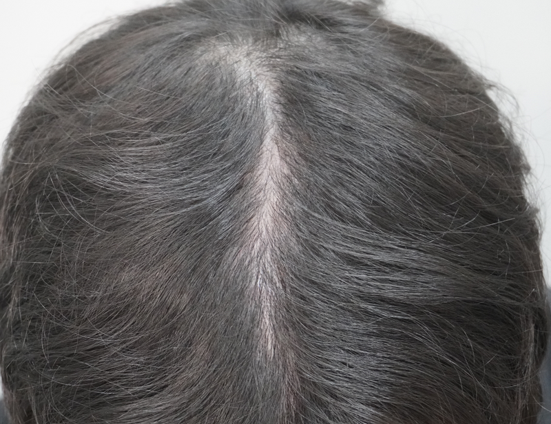 뉴헤어부산의원에서 8회차 치료 후기