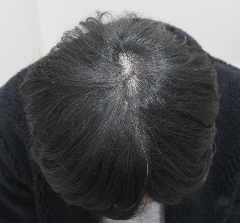 뉴헤어부산점에서 12회차 주사치료 후기