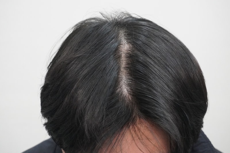 뉴헤어부산의원에서 탈모 극복 하고 있습니다 !!