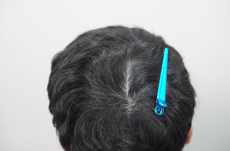 뉴헤어부산점 주사치료 24회차 후기