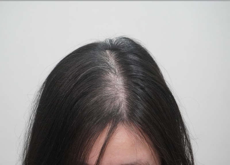 뉴헤어부산점 탈모 치료 8회 차 후기 읽어주세요 ~!