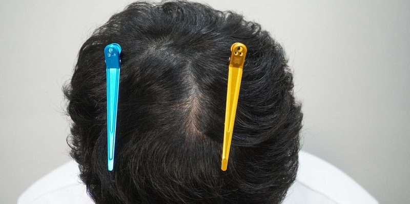 [부산점]뉴헤어모발성형외과에서 주사치료