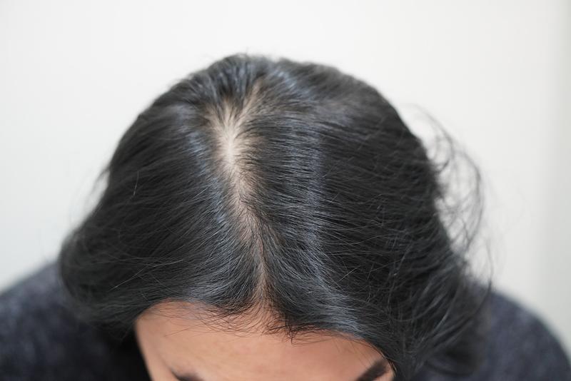 부산 뉴헤어에서 주사치료 12회 마무리 했습니다