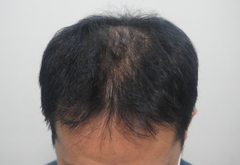 [부산점]뉴헤어부산 에서 탈모치료상담, 시술시작 1회차