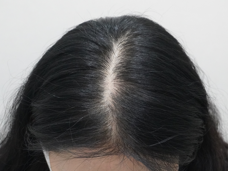 뉴헤어부산에서 정수리,헤어라인 탈모치료 12회 받고왔습니다