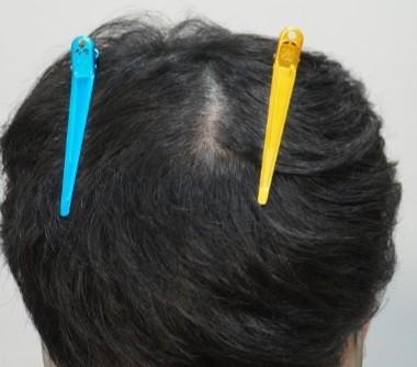 부산 뉴헤어에서 주사치료 12회차(6개월 후기)