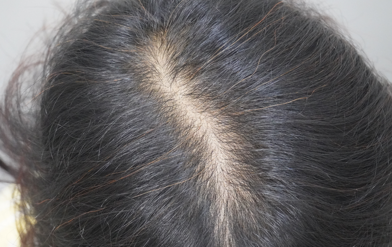 뉴헤어 부산 4회차 모근강화 주사 후기