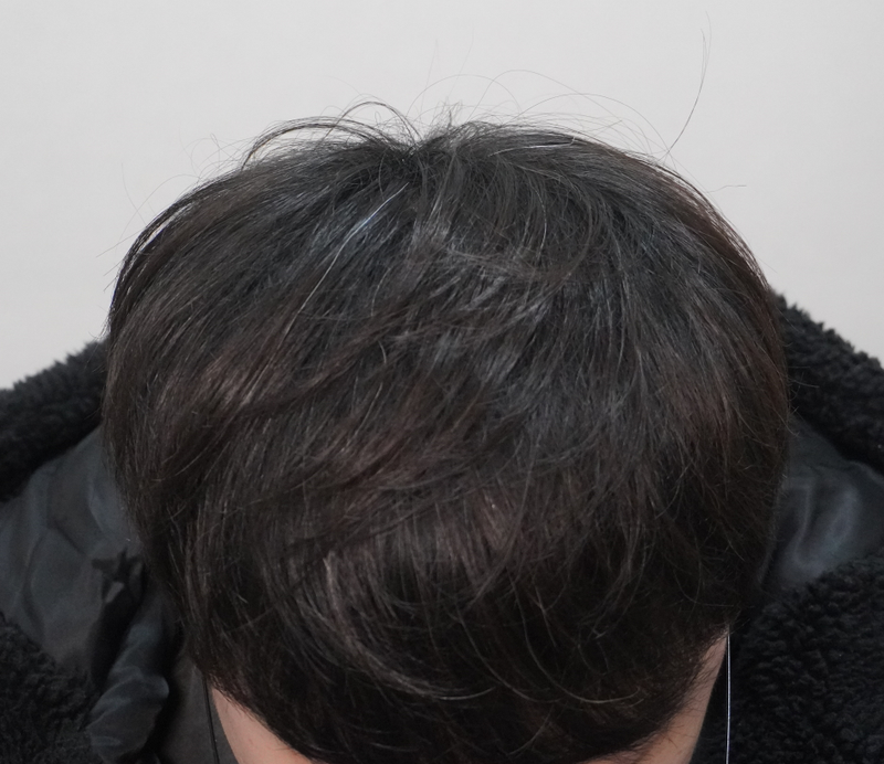 뉴헤어부산의원에서 치료받고 있어요