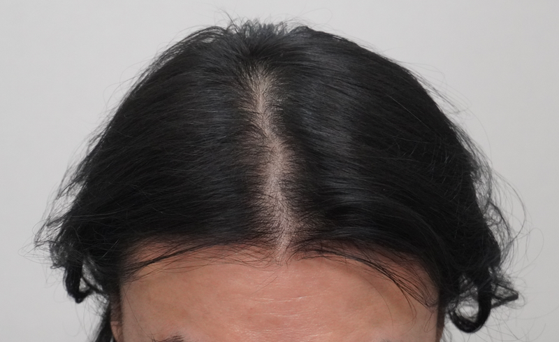 뉴헤어 부산의원에서 8회차 시술받았습니다