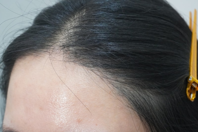 뉴헤어 복합주사치료 4회차입니다