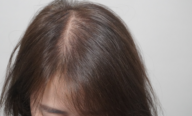 뉴헤어부산의원에서 치료 3회 차 후기