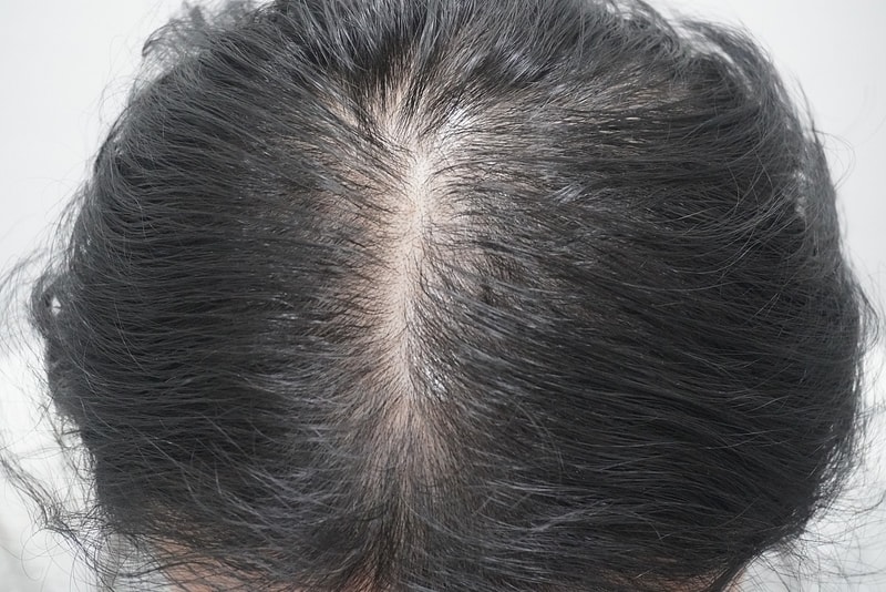 뉴헤어부산의원 모낭주사 4회차