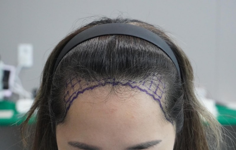 [ 부산점 ] 뉴헤어의원에서 비절개 M자 수술 했습니다