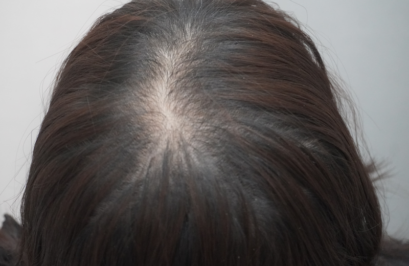 뉴헤어부산의원에서 8회차 탈모 치료 후기