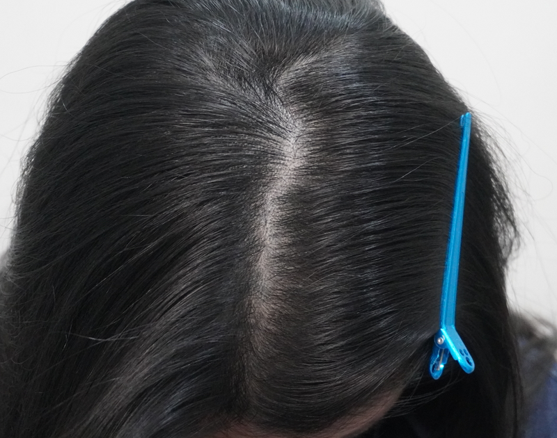 뉴헤어부산에서 주사치료 했습니다!