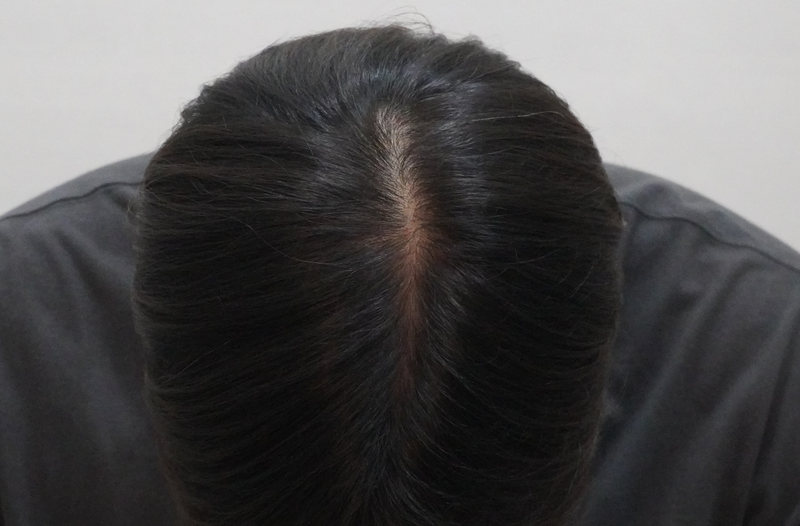 [부산점]뉴헤어모발성형외과에서 치료 시작 했습니다