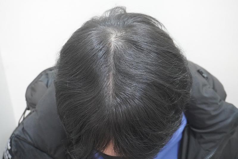 뉴헤어 부산점에서 주사 복합치료 12번째 시술 후기입니다