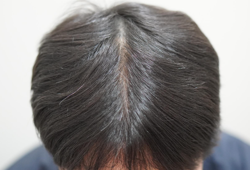 뉴헤어부산의원 주사치료16회차~~