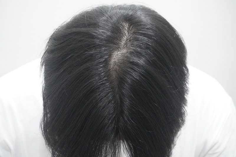 뉴헤어 부산의원 탈모치료 4회차 후기