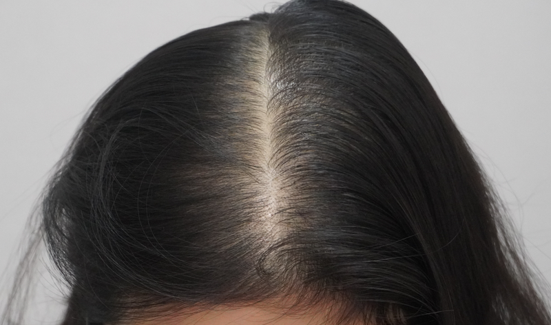 뉴헤어부산의원 탈모 주사 12번째 맞고왔어요