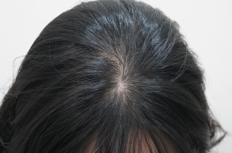 뉴헤어부산의원 탈모 치료 4회 차 후기 입니다