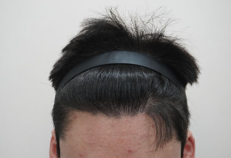 뉴헤어부산의원 탈모 주사 치료 12회 치료했어요