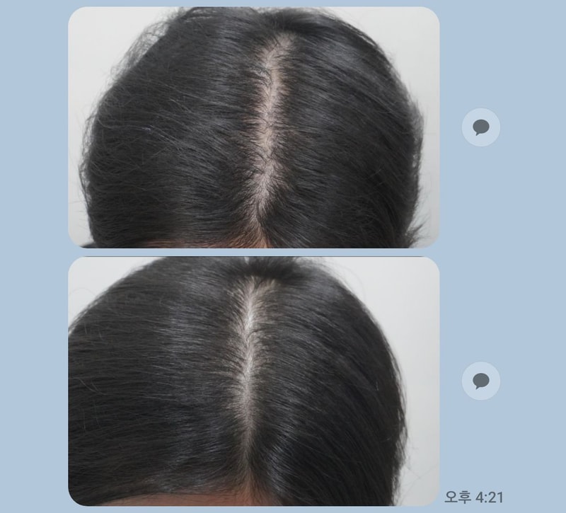 뉴헤어부산의원 해운대점 2달 째 8회 차 치료 후기