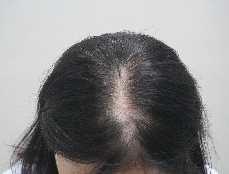 뉴헤어 탈모치료 4회차 주사 치료 후기