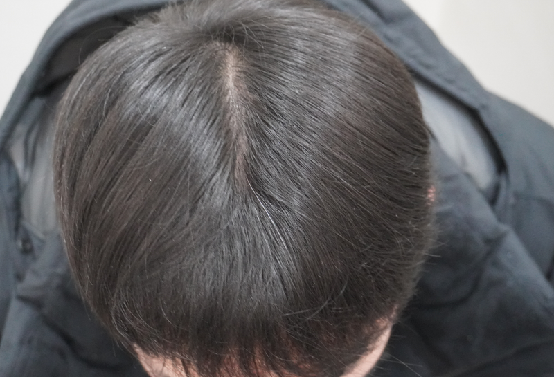 뉴헤어부산의원 주사12회차 마무리 하고 왔습니다~