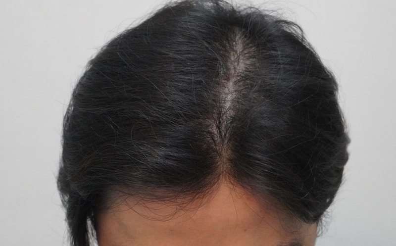 부산 센텀에 위치한 뉴헤어의원에서 엑소톡스 치료 시작