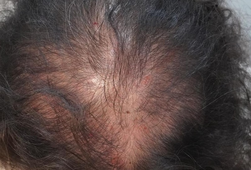 치료 4회 차 후기 예요 ! - 뉴헤어부산점