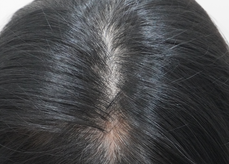 부산 뉴헤어에서 주사치료 8회차