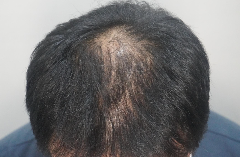 뉴헤어부산의원에서 탈모치료 12회 마무리됐습니다