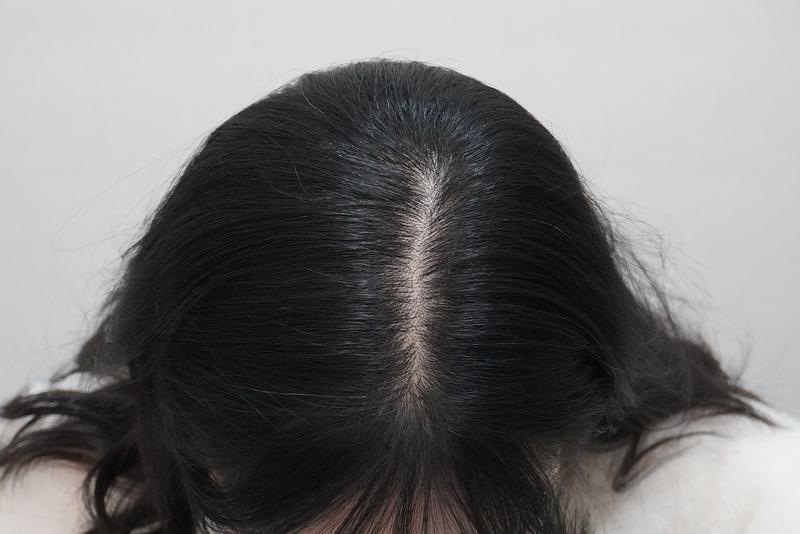 뉴헤어부산의원 탈모 주사 치료 8회차 후기