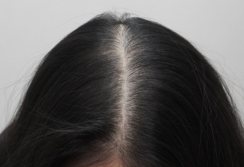 뉴헤어부산의원에서 13번째 치료 후기입니다